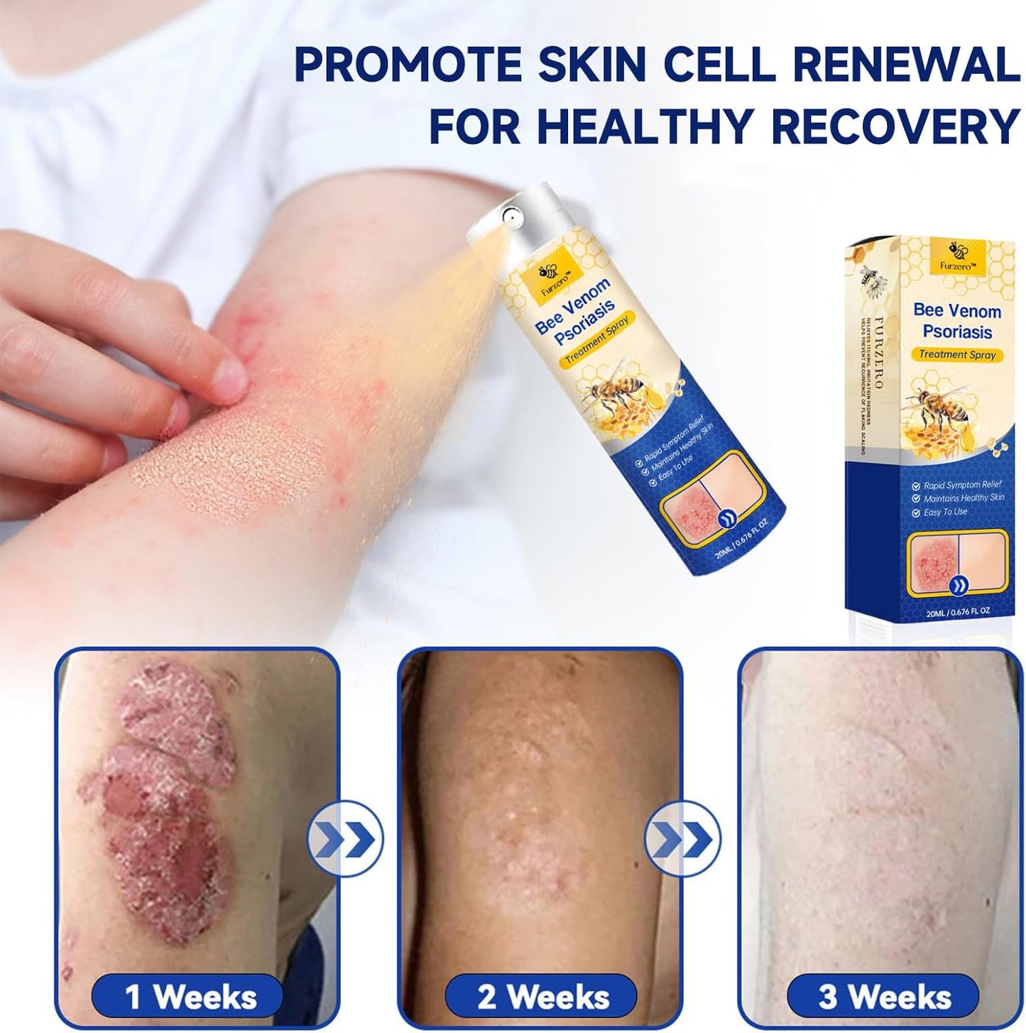 PsoriaFri spray | Omedelbar lindring av envis psoriasis