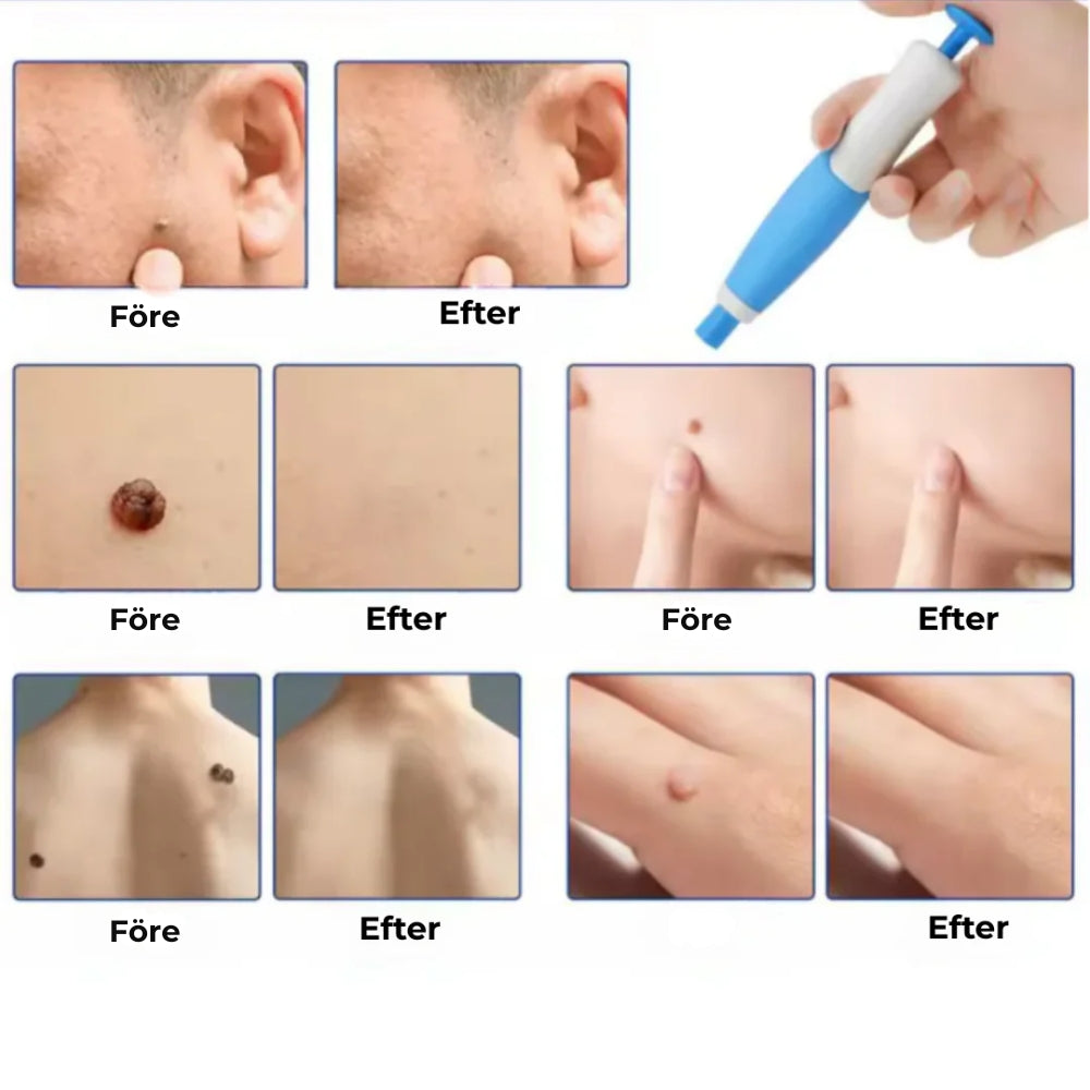 ClearSkin™ Penn – Säker borttagning av hudmärken!