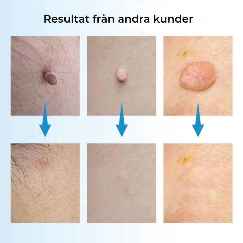 ClearSkin™ Penn – Säker borttagning av hudmärken!