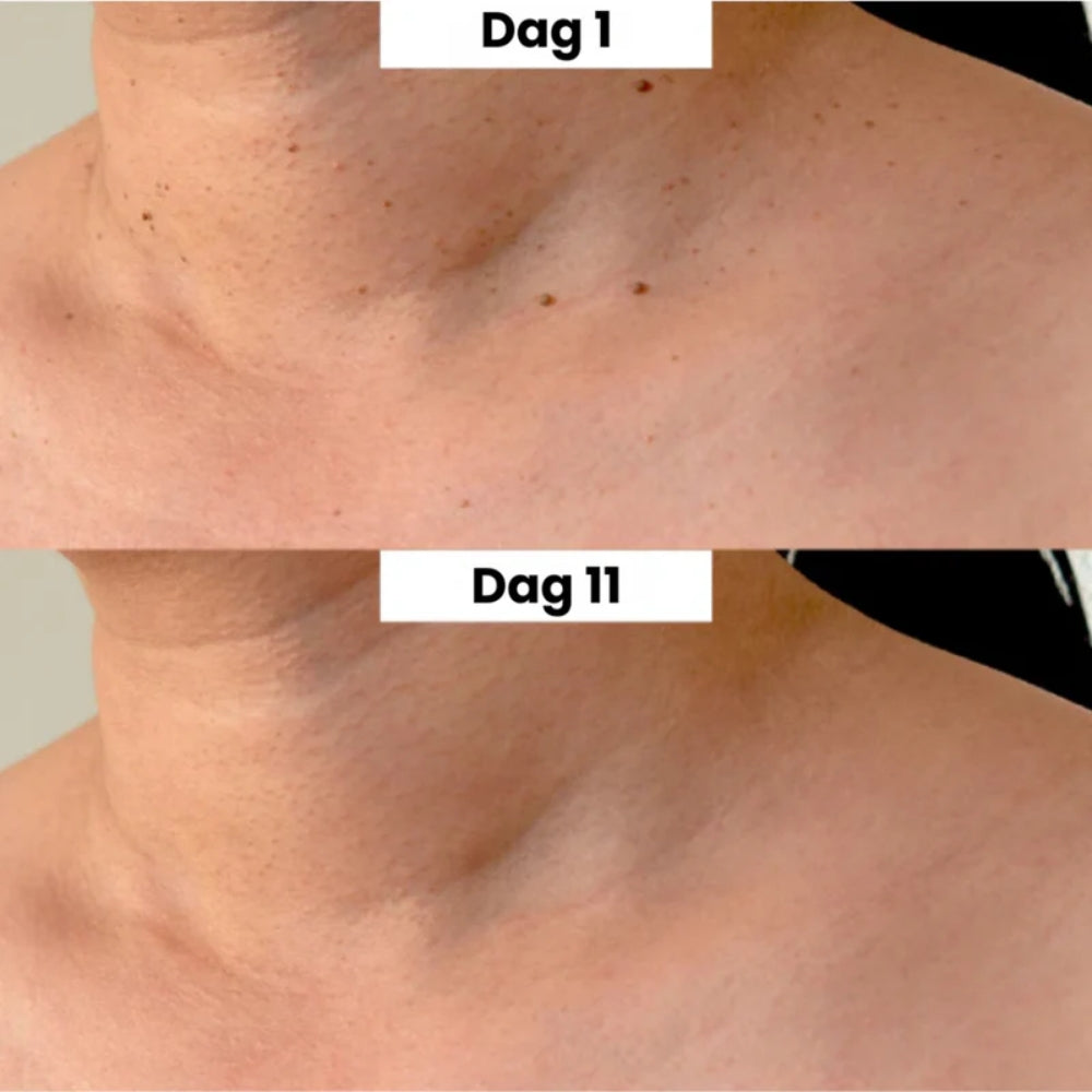 ClearSkin™ Penn – Säker borttagning av hudmärken!
