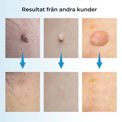 ClearSkin™ Penn – Säker borttagning av hudmärken!
